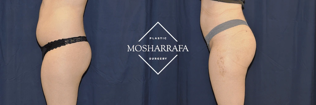 fat-transfer-case-2662