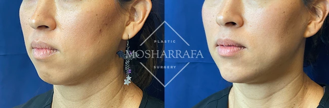 imgi_10_Mosharrafa_Gallery-Filler-chin-228-Left-OBL