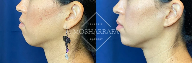 imgi_11_Mosharrafa_Gallery-Filler-chin-228-Left-LAT