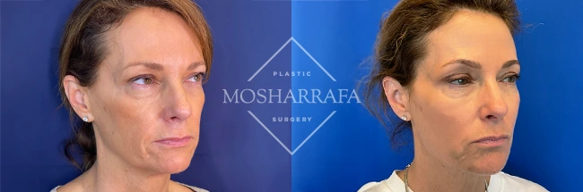 imgi_11_Mosharrafa_Gallery-Filler-full-face-230-Right-OBL