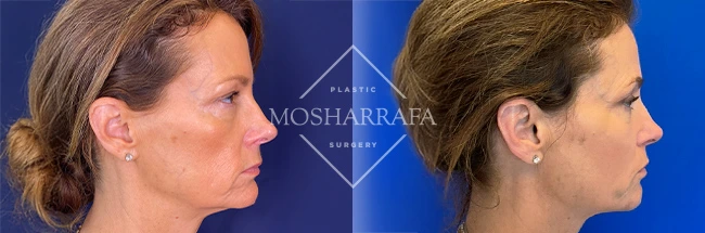 imgi_12_Mosharrafa_Gallery-Filler-full-face-230-Right-LAT