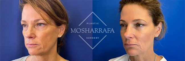 imgi_13_Mosharrafa_Gallery-Filler-full-face-230-Left-OBL