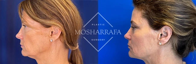 imgi_14_Mosharrafa_Gallery-Filler-full-face-230-Left-LAT