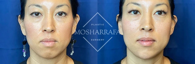 imgi_7_Mosharrafa_Gallery-Filler-chin-228-AP