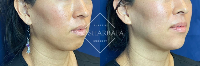 imgi_8_Mosharrafa_Gallery-Filler-chin-228-Right-OBL