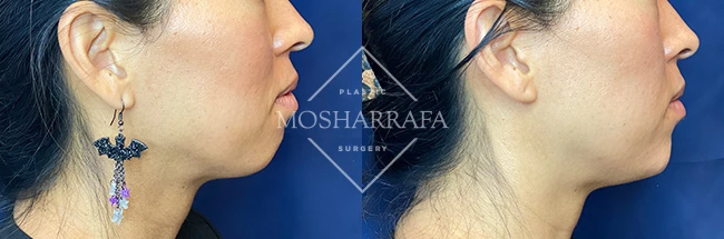 imgi_9_Mosharrafa_Gallery-Filler-chin-228-Right-LAT