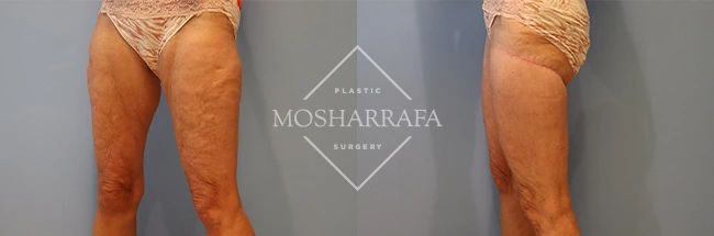 thigh-lift-case-282:2