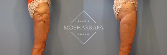 thigh-lift-case-282:3