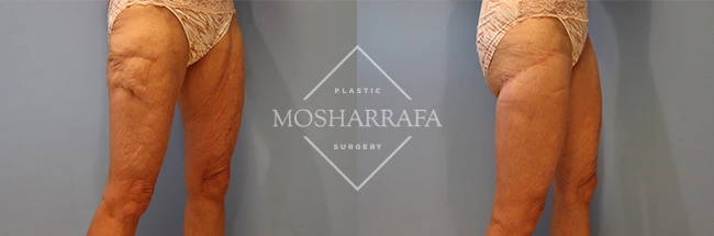 thigh-lift-case-282:4