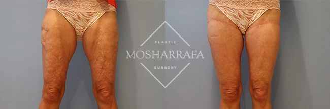 thigh-lift-case-282:5