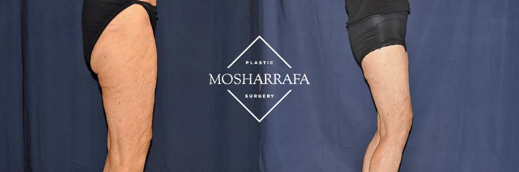 thigh-lift-case-52:2