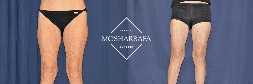 thigh-lift-case-52:3