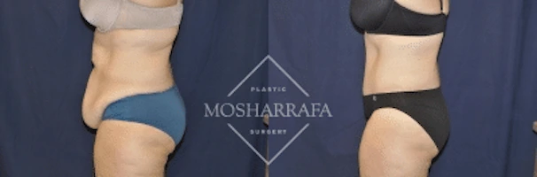 tummy-tuck-case-1332