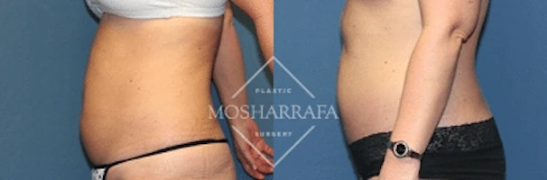 tummy-tuck-case-167-2