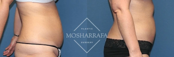 tummy-tuck-case-167-3