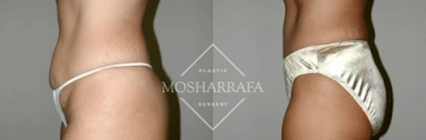 tummy-tuck-case-1702