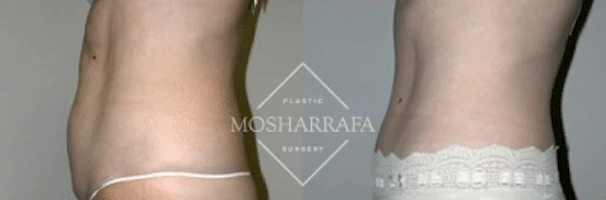 tummy-tuck-case-1912