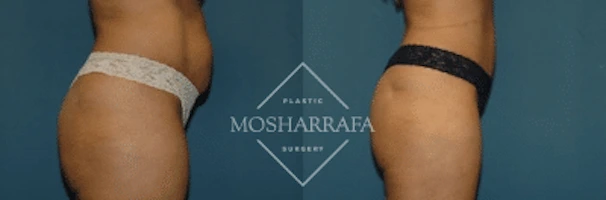 tummy-tuck-case-2112