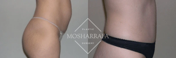 tummy-tuck-case-2162