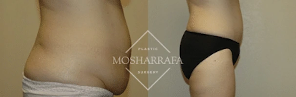 tummy-tuck-case-228-2