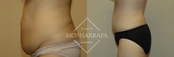 tummy-tuck-case-228-3