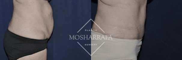 tummy-tuck-case-232-2