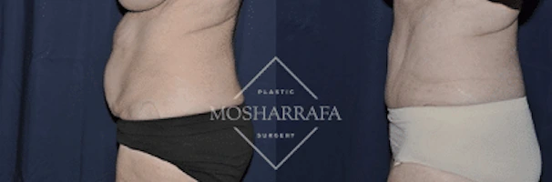 tummy-tuck-case-232-3