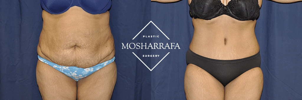 tummy-tuck-case-244-1