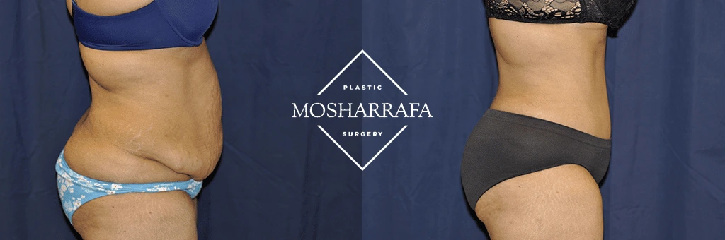 tummy-tuck-case-244-2