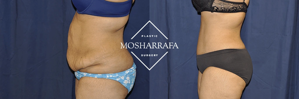 tummy-tuck-case-244-3