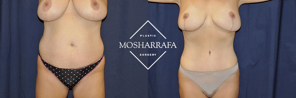 tummy-tuck-case-268-1