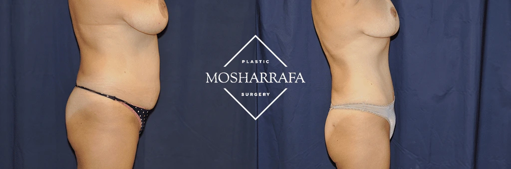 tummy-tuck-case-268-2