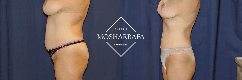 tummy-tuck-case-268-3