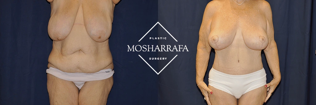 tummy-tuck-case-298-1