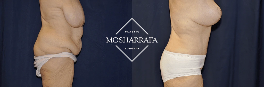 tummy-tuck-case-298-2