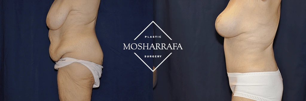 tummy-tuck-case-298-3