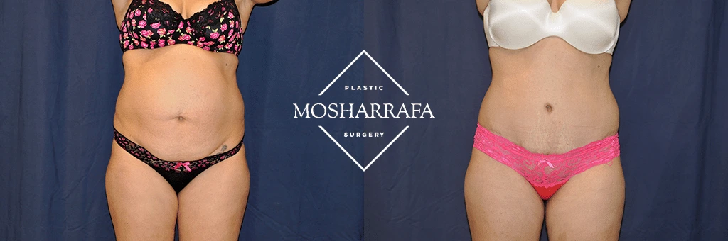tummy-tuck-case-304-1
