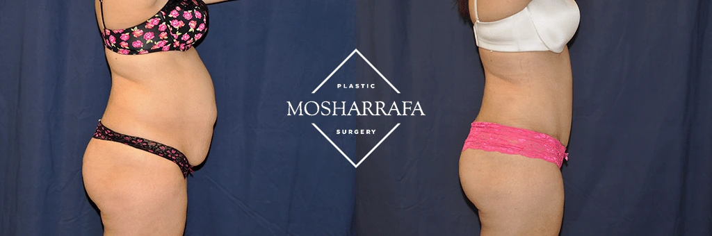 tummy-tuck-case-304-2