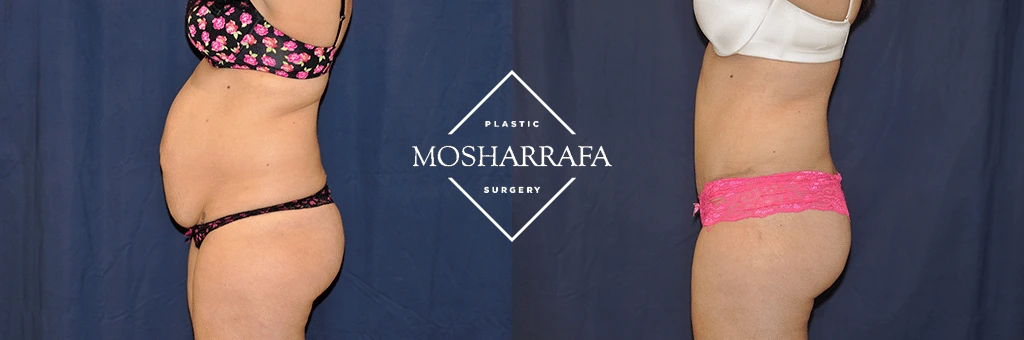 tummy-tuck-case-304-3